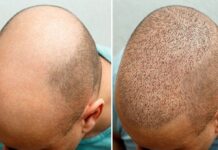 5 Things to Consider Before Getting a Hair Transplant Hair Transplant